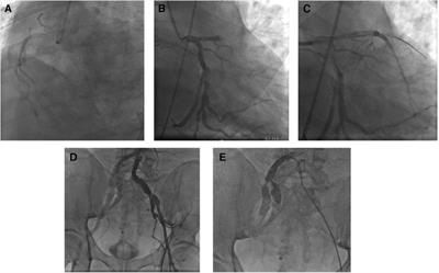 Concomitant percutaneous coronary intervention and transcatheter aortic valve replacement for aortic stenosis complicated with acute STEMI: a case report and literature review